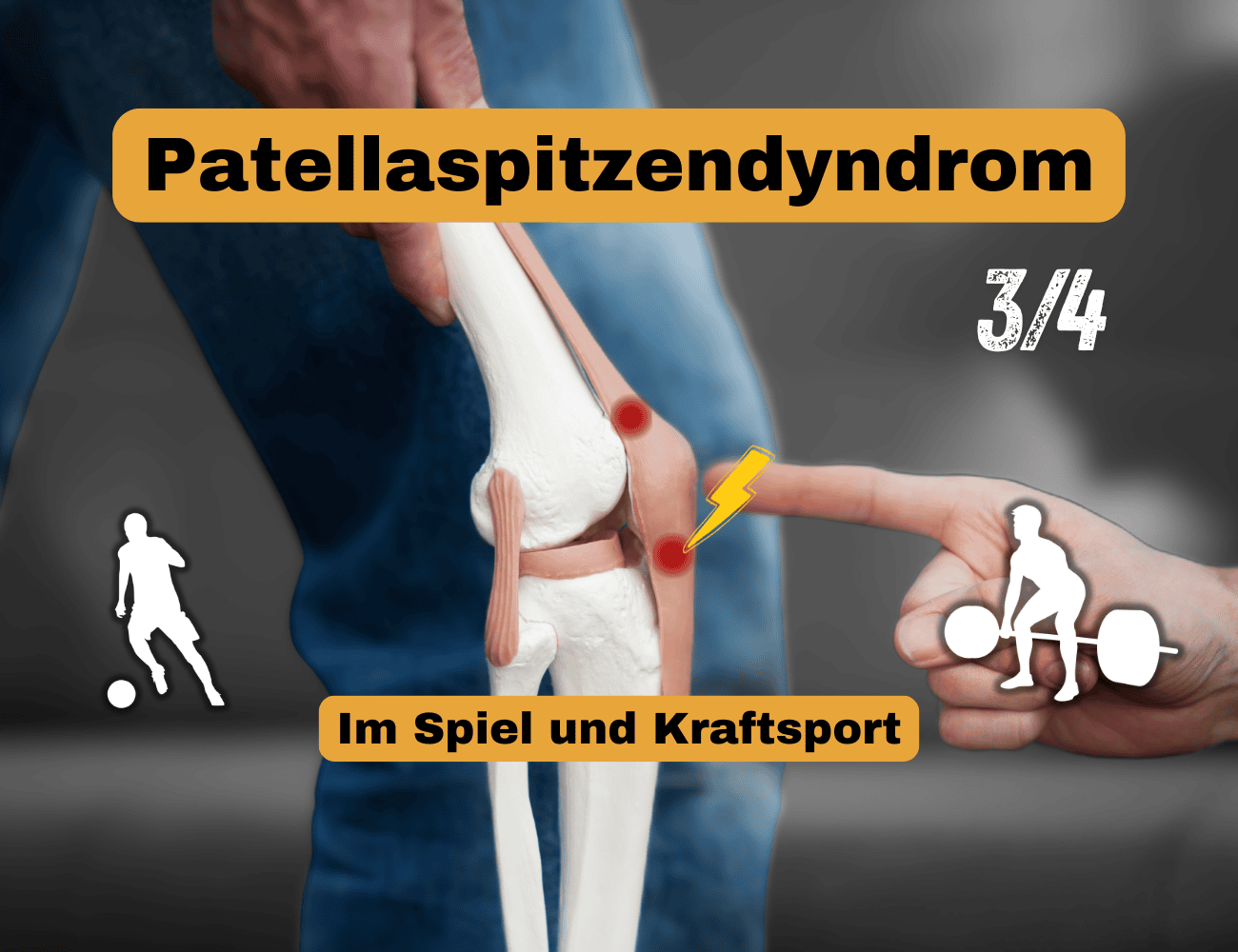 Wie beeinflusst das Patellaspitzensyndrom Spiel- und Kraftsport?